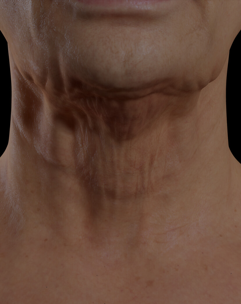 Patiente de la Clinique Chloé présentant du relâchement cutané dans le cou traitée avec le Venus Legacy