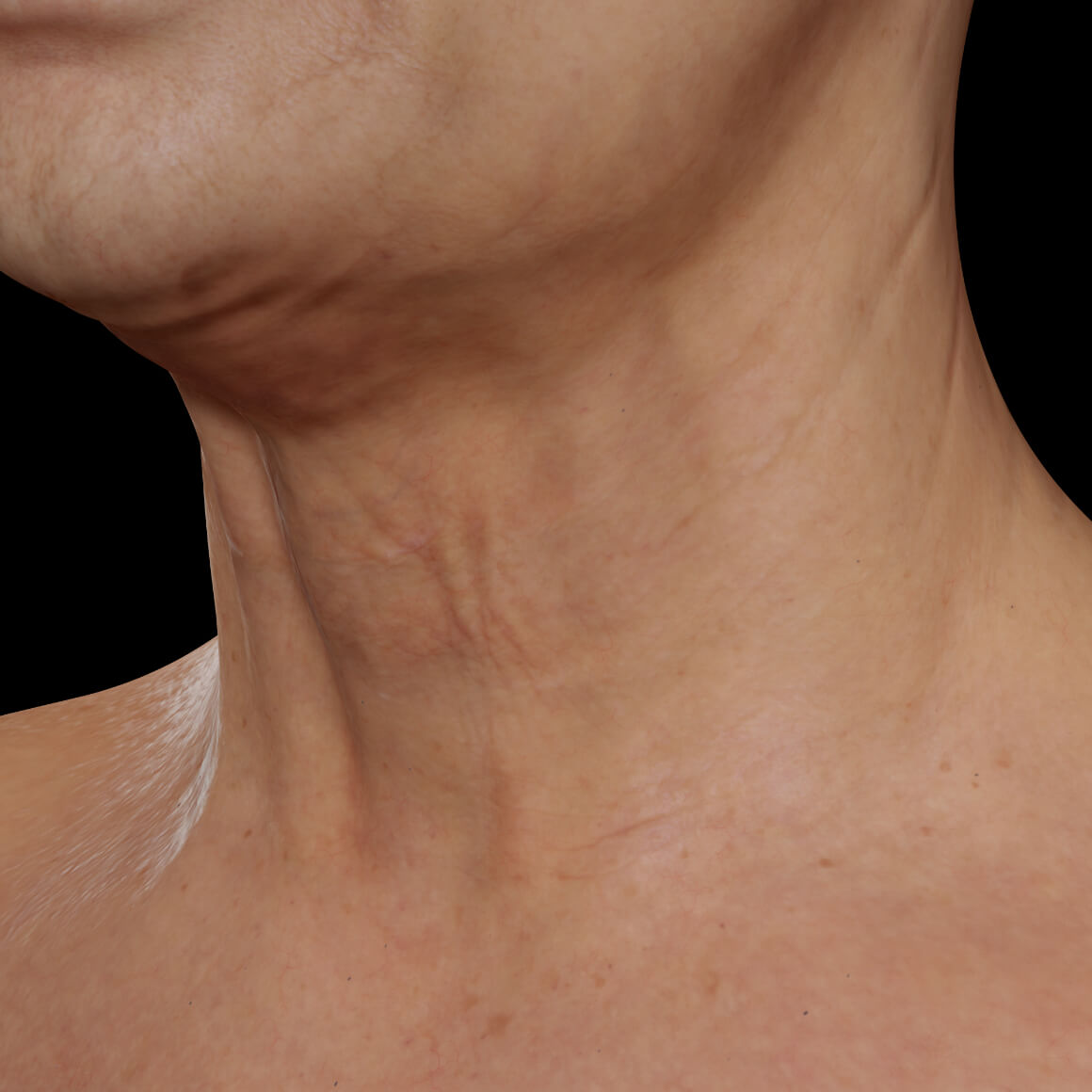 Patiente de la Clinique Chloé vue en angle après des traitements de Venus Legacy pour le raffermissement du cou
