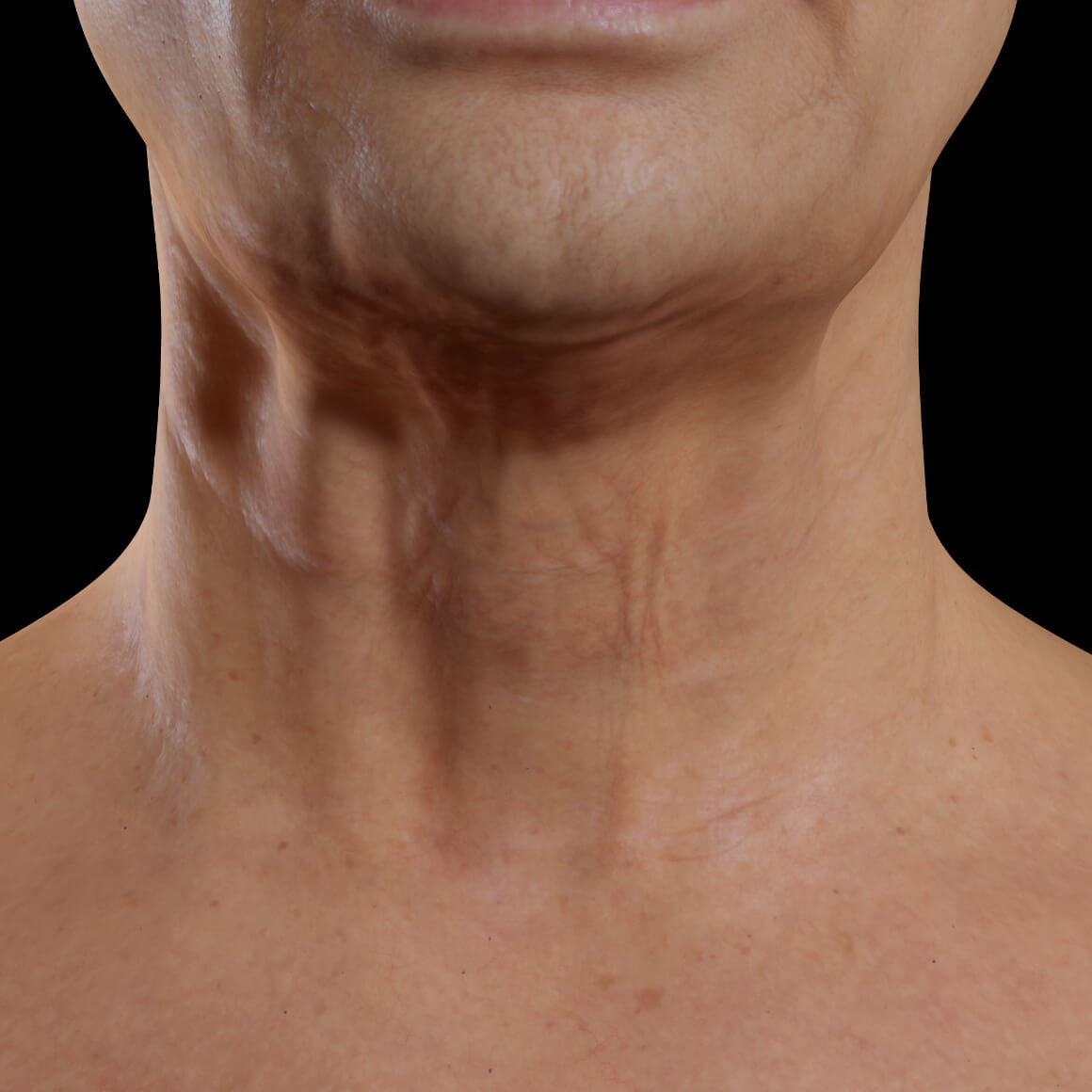Patiente de la Clinique Chloé vue de face après des traitements de Venus Legacy pour le raffermissement du cou